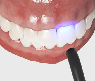 dental bonding teeth in Whitby, ON.